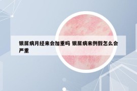 银屑病月经来会加重吗 银屑病来例假怎么会严重