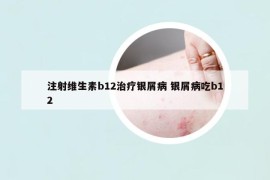 注射维生素b12治疗银屑病 银屑病吃b12