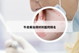牛皮癣治得好的医院排名
