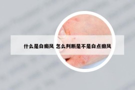 什么是白癜风 怎么判断是不是白点癫风