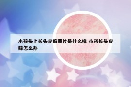 小孩头上长头皮癣图片是什么样 小孩长头皮藓怎么办
