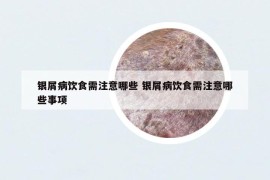 银屑病饮食需注意哪些 银屑病饮食需注意哪些事项
