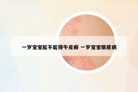 一岁宝宝能不能得牛皮癣 一岁宝宝银屑病