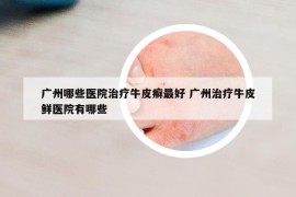 广州哪些医院治疗牛皮癣最好 广州治疗牛皮鲜医院有哪些