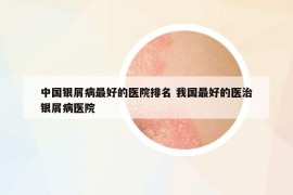 中国银屑病最好的医院排名 我国最好的医治银屑病医院