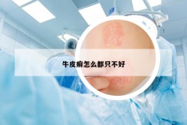 牛皮癣怎么都只不好
