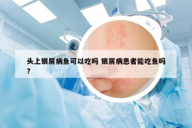 头上银屑病鱼可以吃吗 银屑病患者能吃鱼吗?