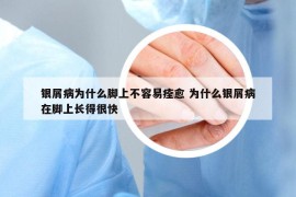 银屑病为什么脚上不容易痊愈 为什么银屑病在脚上长得很快