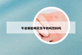 牛皮癣能喝花生牛奶吗饮料吗