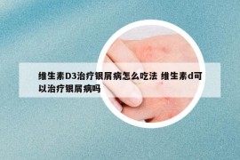 维生素D3治疗银屑病怎么吃法 维生素d可以治疗银屑病吗