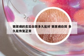 银屑病的愈后白斑多久能好 银屑病白斑 多久能恢复正常