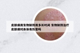 皮肤病用生物制剂用多长时间 生物制剂治疗皮肤病对身体有伤害吗