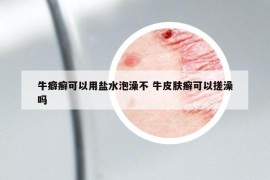 牛癖癣可以用盐水泡澡不 牛皮肤癣可以搓澡吗