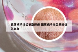 银屑病手指关节涨还痒 银屑病手指关节肿痛怎么办