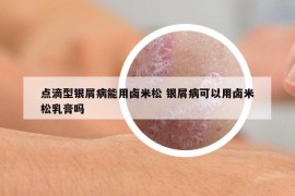 点滴型银屑病能用卤米松 银屑病可以用卤米松乳膏吗