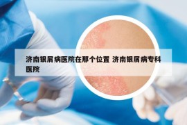 济南银屑病医院在那个位置 济南银屑病专科医院