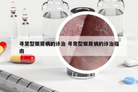 寻常型银屑病的诊治 寻常型银屑病的诊治指南