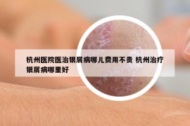 杭州医院医治银屑病哪儿费用不贵 杭州治疗银屑病哪里好