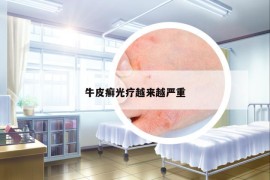 牛皮癣光疗越来越严重