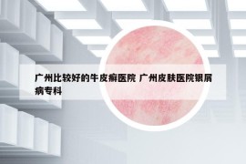 广州比较好的牛皮癣医院 广州皮肤医院银屑病专科