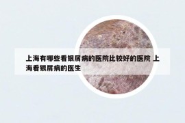 上海有哪些看银屑病的医院比较好的医院 上海看银屑病的医生
