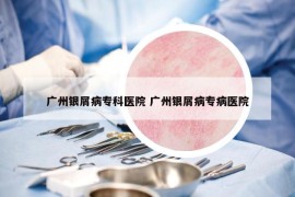 广州银屑病专科医院 广州银屑病专病医院