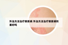 外治方法治疗银屑病 外治方法治疗银屑病效果好吗