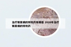 治疗银屑病的特效药有哪些 2020年治疗银屑病的特效药