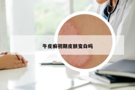 牛皮癣初期皮肤变白吗