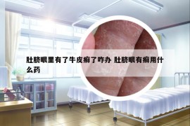 肚脐眼里有了牛皮癣了咋办 肚脐眼有癣用什么药