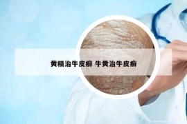 黄精治牛皮癣 牛黄治牛皮癣