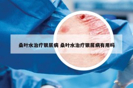 桑叶水治疗银屑病 桑叶水治疗银屑病有用吗