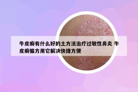 牛皮癣有什么好的土方法治疗过敏性鼻炎 牛皮癣偏方用它解决快捷方便