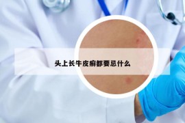 头上长牛皮癣都要忌什么