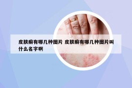 皮肤癣有哪几种图片 皮肤癣有哪几种图片叫什么名字啊