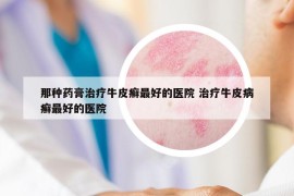 那种药膏治疗牛皮癣最好的医院 治疗牛皮病癣最好的医院