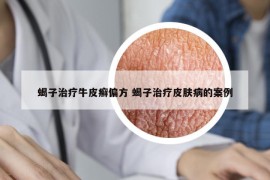 蝎子治疗牛皮癣偏方 蝎子治疗皮肤病的案例