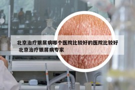 北京治疗银屑病哪个医院比较好的医院比较好 北京治疗银屑病专家