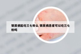 银屑病能吃三七粉么 银屑病患者可以吃三七粉吗