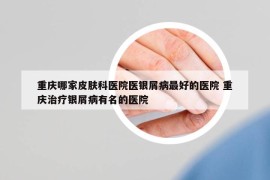 重庆哪家皮肤科医院医银屑病最好的医院 重庆治疗银屑病有名的医院