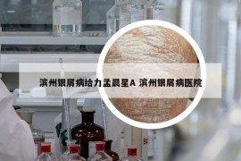 滨州银屑病给力孟晨星A 滨州银屑病医院