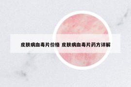 皮肤病血毒片价格 皮肤病血毒片药方详解