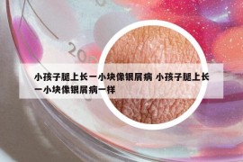 小孩子腿上长一小块像银屑病 小孩子腿上长一小块像银屑病一样