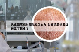 头皮银屑病前额发红怎么办 头部银屑病发红但是不起皮了