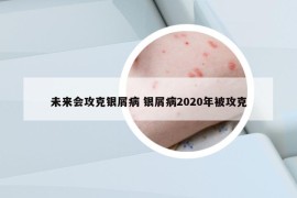 未来会攻克银屑病 银屑病2020年被攻克