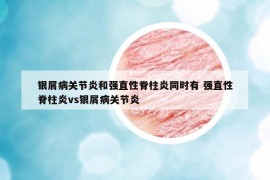 银屑病关节炎和强直性脊柱炎同时有 强直性脊柱炎vs银屑病关节炎
