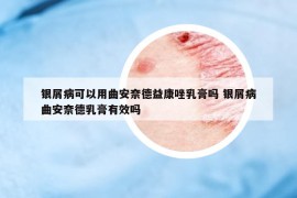 银屑病可以用曲安奈德益康唑乳膏吗 银屑病曲安奈德乳膏有效吗