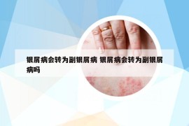 银屑病会转为副银屑病 银屑病会转为副银屑病吗