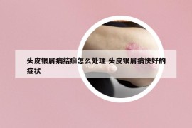 头皮银屑病结痂怎么处理 头皮银屑病快好的症状