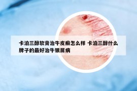 卡泊三醇软膏治牛皮癣怎么样 卡泊三醇什么牌子的最好治牛银屑病